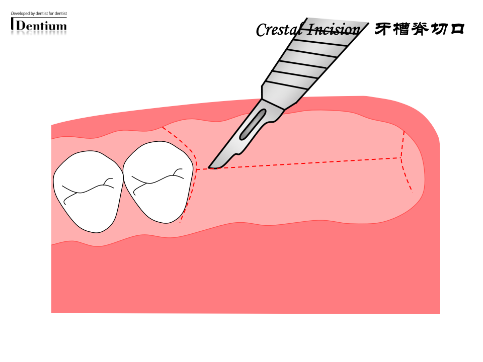 口腔-登腾种植手术指南-淄博口腔医院.ppt 第4页