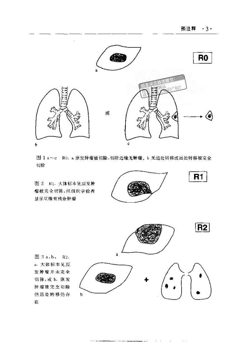 国际抗癌联盟肿瘤tnm分期图谱（扫描版）.pdf 第3页