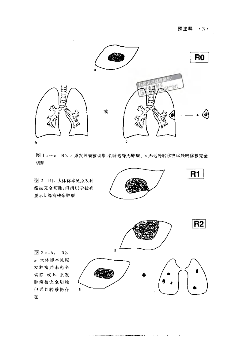 国际抗癌联盟肿瘤TNM分期图谱.pdf 第4页