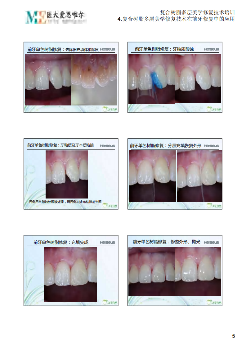 4.复合树脂多层美学修复技术在前牙修复中的应用.PDF 第5页