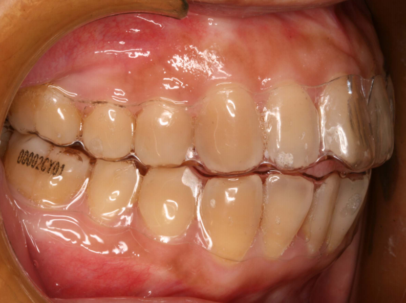 178隐形正畸临床体会.pdf 第5页