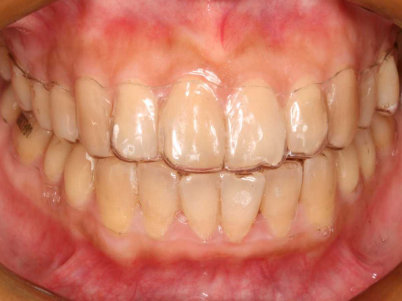 大川分享_隐形正畸临床体会.pdf 第4页