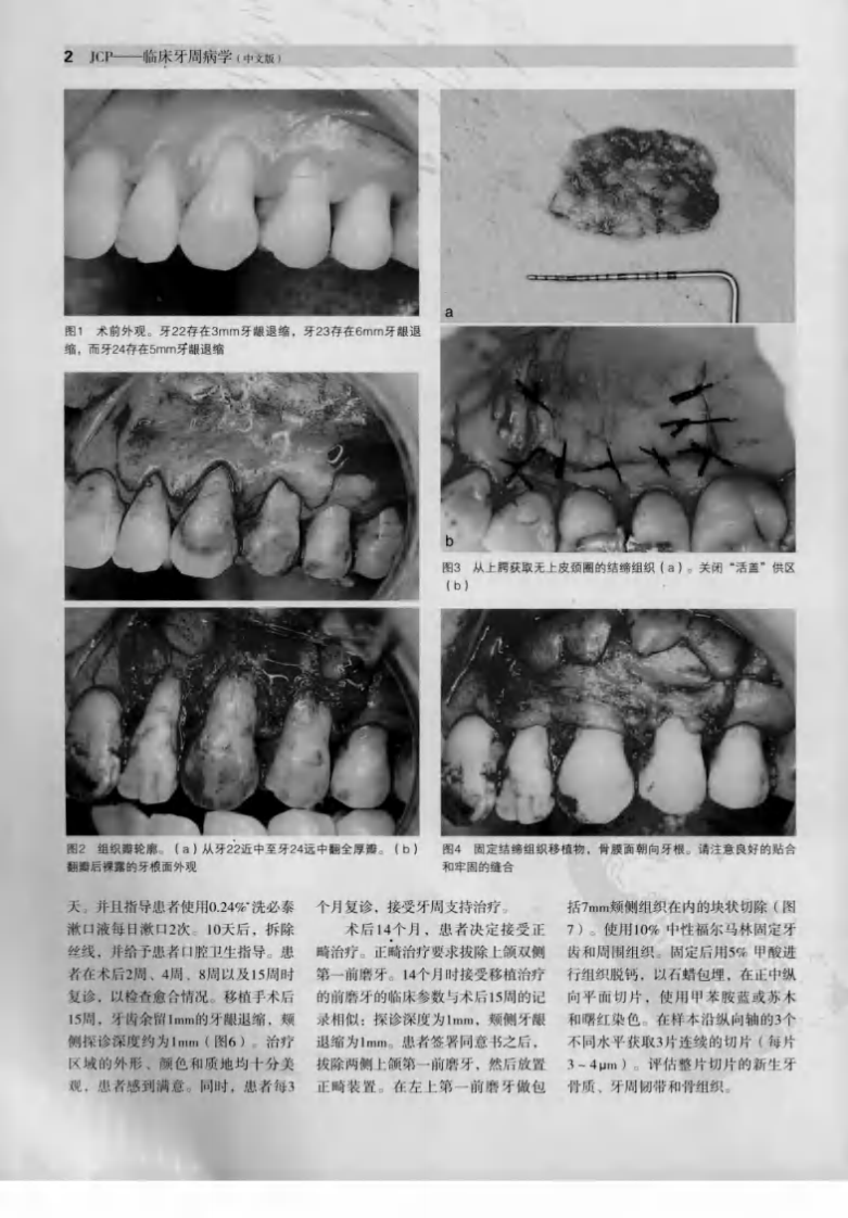 大川分享_临床牙周病学  根面覆盖与牙周组织再生专辑  中文版_（意）托尼提主编.pdf 第5页