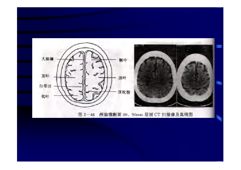 颅脑CT、MRI.pdf 第5页