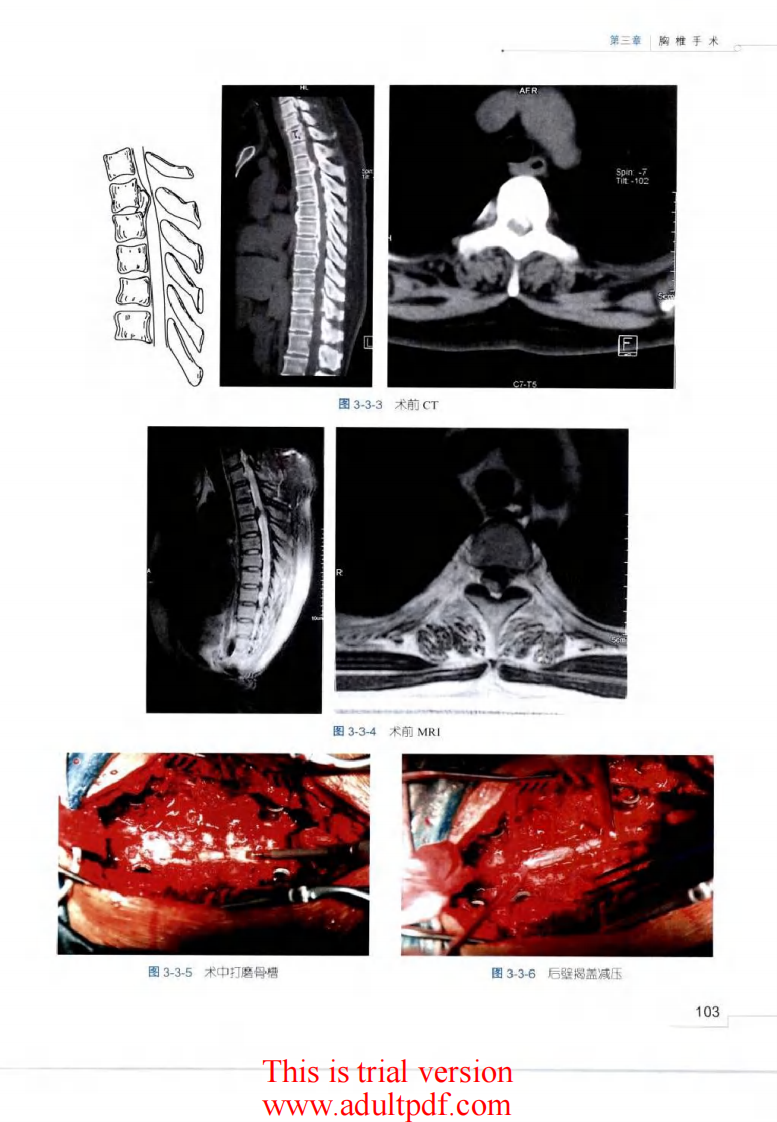 脊柱外科手术操作与技巧（骨科手术技巧丛书）3.pdf 第4页