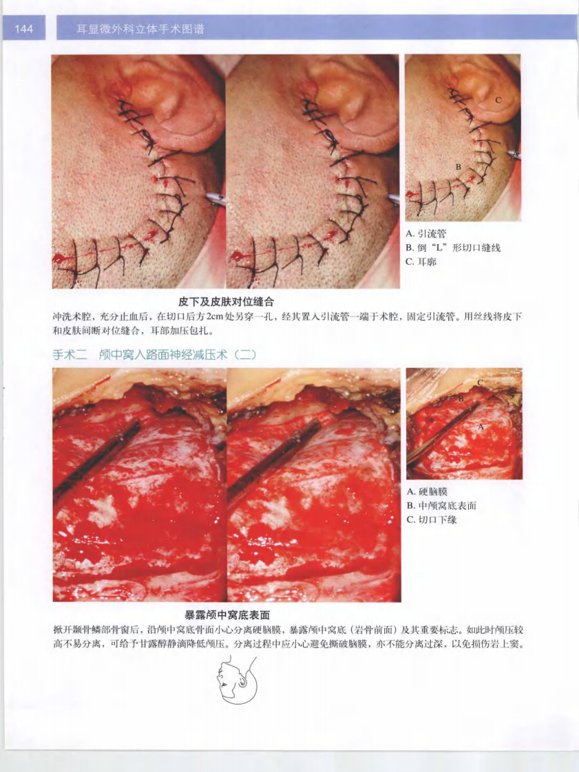 耳显微外科立体手术图谱2.pdf 第4页