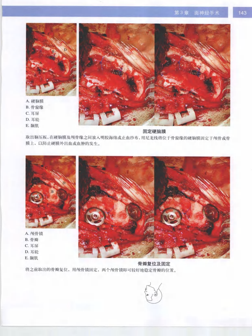 耳显微外科立体手术图谱2.pdf 第3页