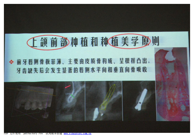 152宿玉成 上颌前部种植和种植美学原则.pdf 第5页