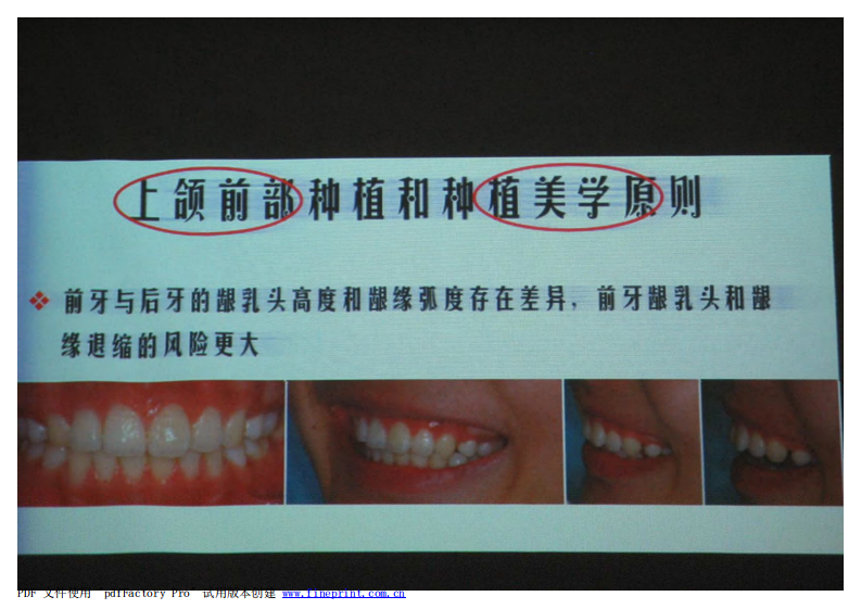 152宿玉成 上颌前部种植和种植美学原则.pdf 第4页